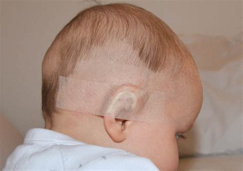 Use Of Tapes In Ear Deformities Babies Dr Onganlar