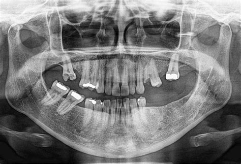 Tórus Mandibular é Grave