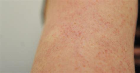 What Causes Those Red Bumps Aka Chicken Skin On Your Arms And How Do