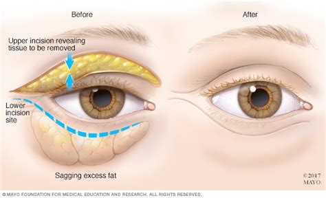 How Blepharoplasty Is Done Mayo Clinic