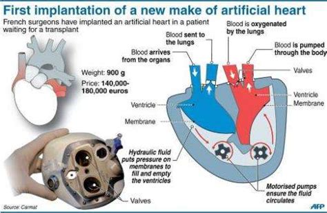 Second Artificial Heart Implant Due In Weeks