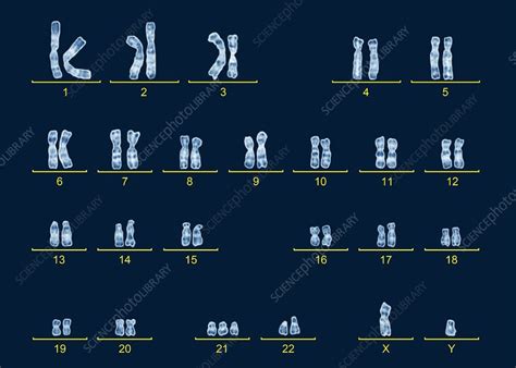 Male Karyotype With Down S Syndrome Stock Image C Science