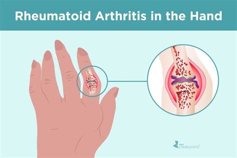 Rheumatoid Arthritis In The Hands Symptoms And Treatments