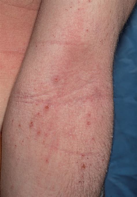 Atopic Dermatitis Pictures On Arms Img Paraquat