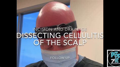Dissecting Cellulitis Of The Scalp Id Of Pus Pockets Drainage Of