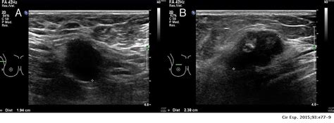 Axillary Lymphadenopathy As The Debut Of A Carcinoma Arising In A