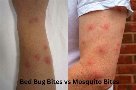Bed Bug Bites Vs Mosquito Bites How To Identify Them