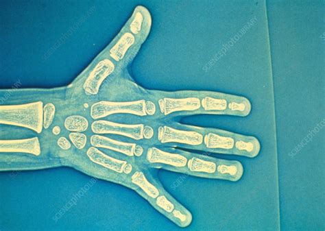 Child Hand X Ray Stock Image P1160430 Science Photo Library