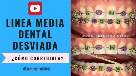 Línea Media Dental Desviada ¿cómo Corregirla Youtube