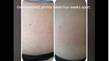 Can Makeup Cover Up Stretch Marks