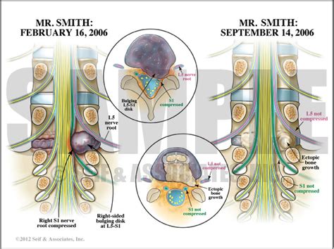 Lumbar Nerve Root Case Study Sanda Medical Graphics