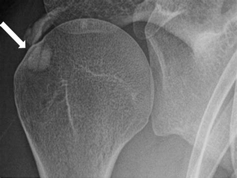 Arthroscopic Removal Of Intraosseous And Intratendinous Deposits In