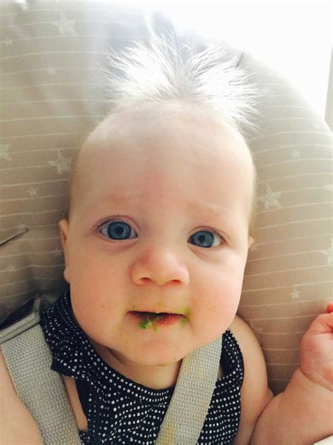 Looks similar to sunburn and covers most of the body. This Adorable Toddler Has 'Uncombable Hair Syndrome', And ...