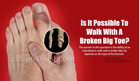 Is It Possible To Walk With A Broken Big Toe