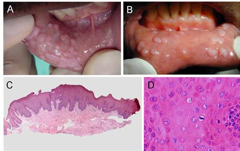 Oral HPV Related Diseases A Review And An Update IntechOpen