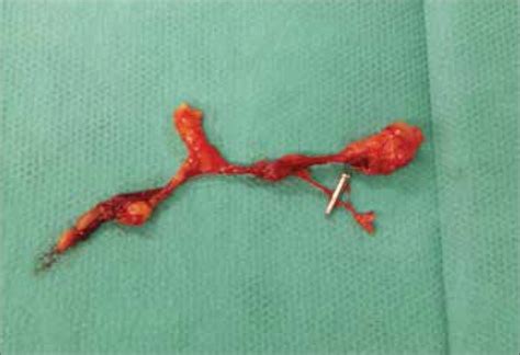 Lymph Node In Case Of Prostate Cancer In White Light After Excision