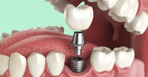 A Guide To Healing Abutments Brighton Implant Clinic Dental Implants