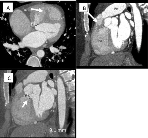 Double Chambered Right Ventricle Diagnosed On Cardiac Cta A Case