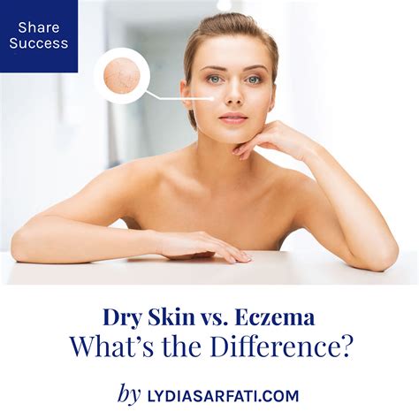 Dry Skin Vs Eczema Whats The Difference And How To Address These