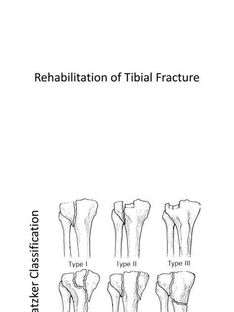 Pdf Rehabilitation Of Tibial Plateau Fracture Dokumentips