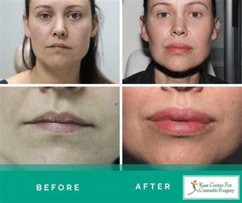 Fat Grafting Lips Before And After Lipstutorial Org