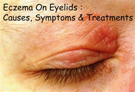 Images Of Eczema On Eyes Eczema Atopic Dermatitis Is An