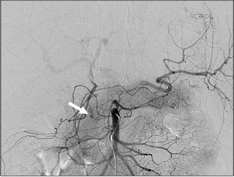 Selective Mesenteric Angiography Showing Extravasation Of Contrast
