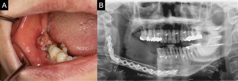 Mandibular Reconstruction With A Ready Made Type And A Custom Made Type