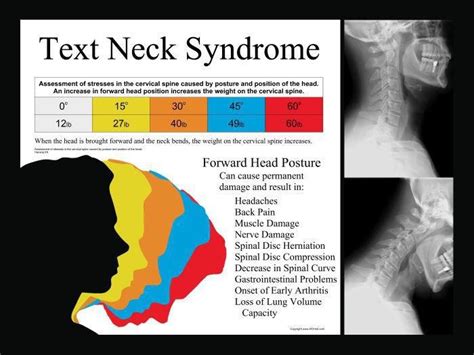 Text Neck 21st Century Syndrome Lafayette Physical Therapy