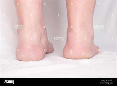 Female Feet With Spots On A White Background With Heel Spur Disease