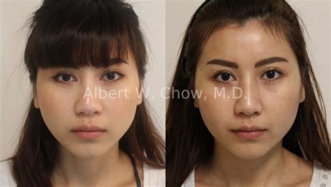 Asian Rhinoplasty Before And After Photo Gallery San Francisco CA Albert W Chow M D