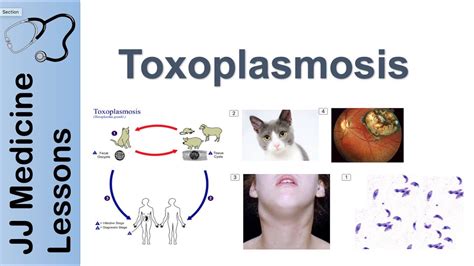 Toxoplasmosis Acquired Vs Congenital Signs Symptoms Diagnosis And