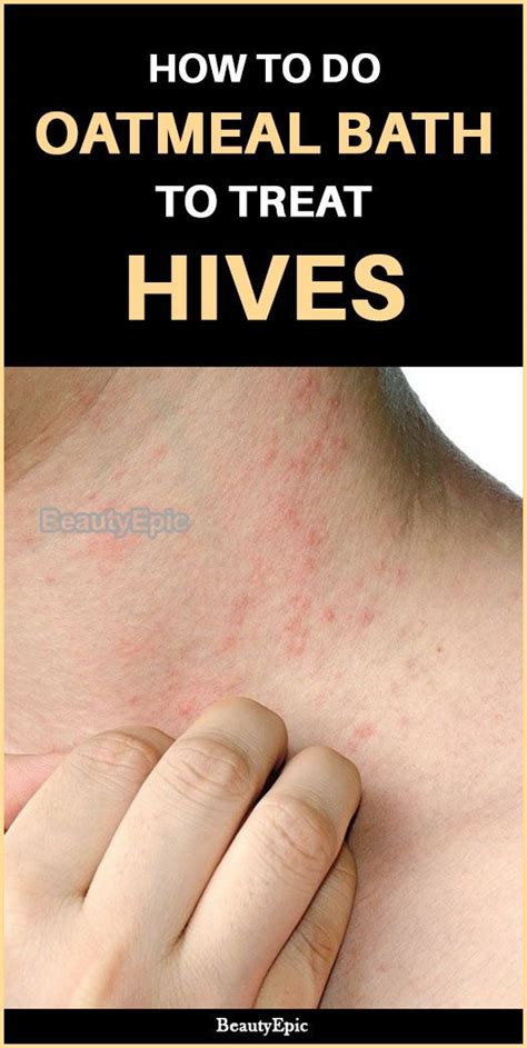 What Do Hives Look Like When Going Away Dowta