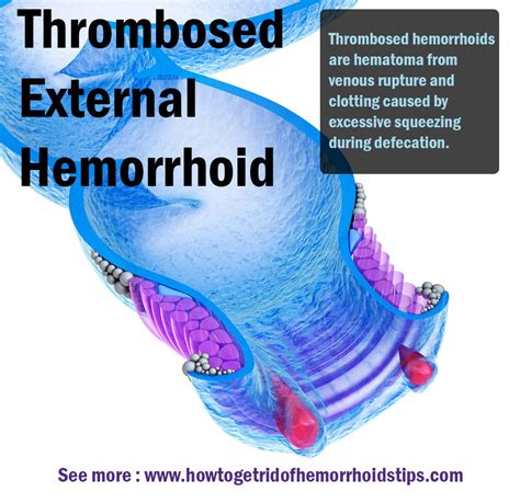 Thrombosed External Hemorrhoid By Carehemorrhoids On Deviantart