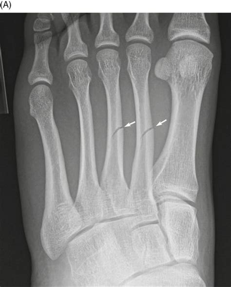 Fractures And Dislocations Of The Metatarsals And Toes Anesthesia Key