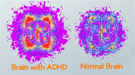 Adhd Brain Vs Normal Brain Functions Differences And More