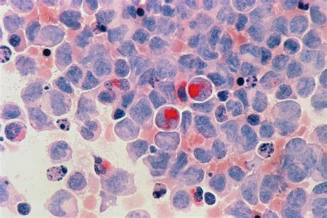 New Treatment For Acute Myeloid Leukaemia Could Prove Beneficial For