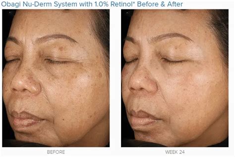 How To Use Retin A For Wrinkles And Why It Works