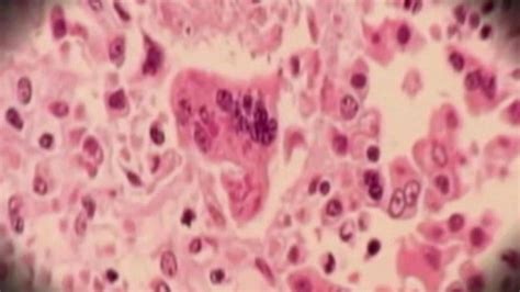 Measles Outbreak Has Spread To 14 States 84 Cases This