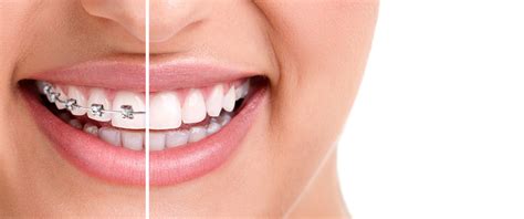 The Many Health Benefits Of Braces Thomas Orthodontics