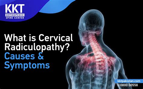 What Is Cervical Radiculopathy Causes And Symptoms Testingform