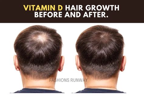 Vitamin D Hair Growth Before And After Fashions Runway