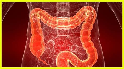 Ulcerative Colitis Causes Symptoms And Treatment Youtube