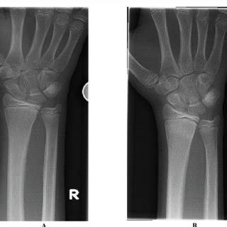 Example Of Non Angulated Wrist Fracture Initial Imaging A And Follow Up B Download