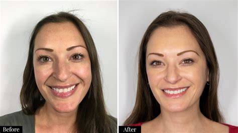 An Honest Review Of Filler For Smile Lines The Vein Center