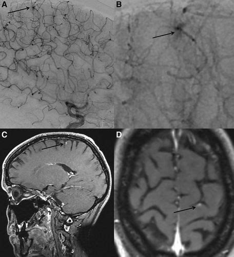 Patient information on what is hereditary hemorrhagic telangiectasia (hht), know the signs and symptoms of hht and how to know if you have it. Cerebrovascular Manifestations of Hereditary Hemorrhagic Telangiectasia | Stroke
