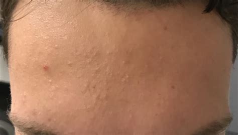 Small Bumps All Over Forehead Folliculitis General Acne