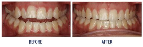 Check spelling or type a new query. What is Overbite, Underbite, Openbite, Crossbite in ...