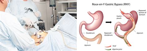 What Happens During Laparoscopic Gastric Bypass Surgery