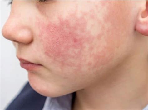 Slapped Cheek Syndrome Important Facts About This Viral Infection